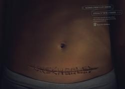 C-section Scar Campaign