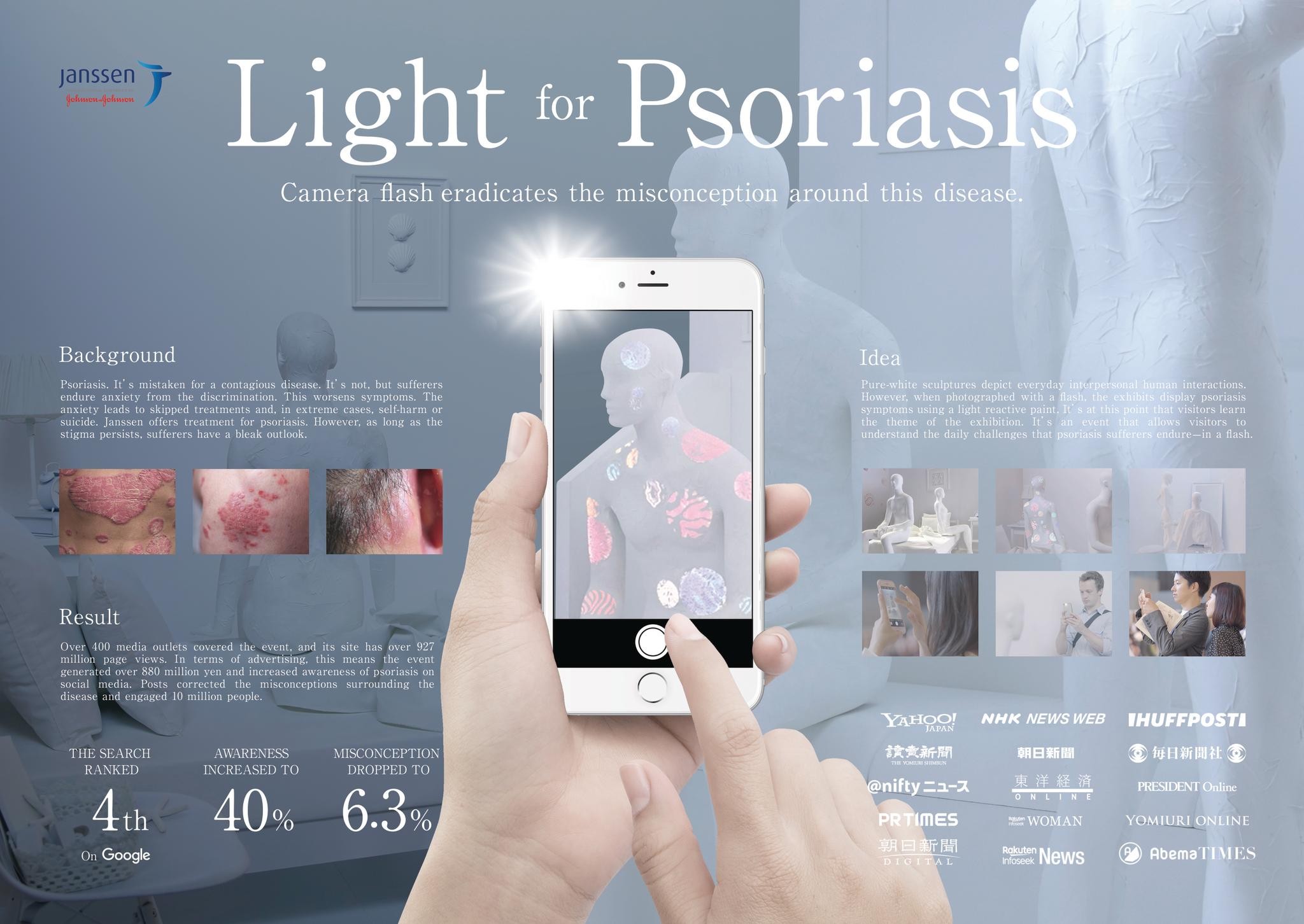 Light for Psoriasis